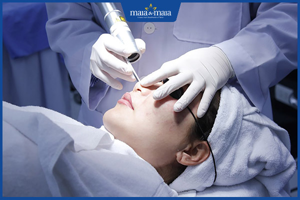 trị mụn cơm công nghệ laser