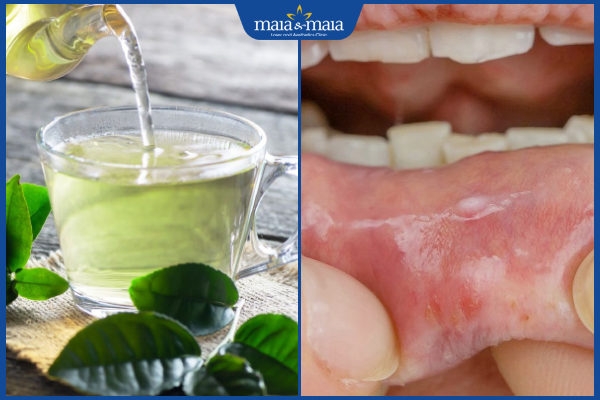 trị mụn nước trong miệng