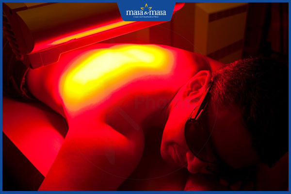 trị sùi mào gà bằng phương pháp ALA-PDT