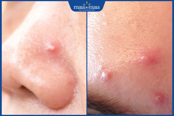 vị trí mụn mủ