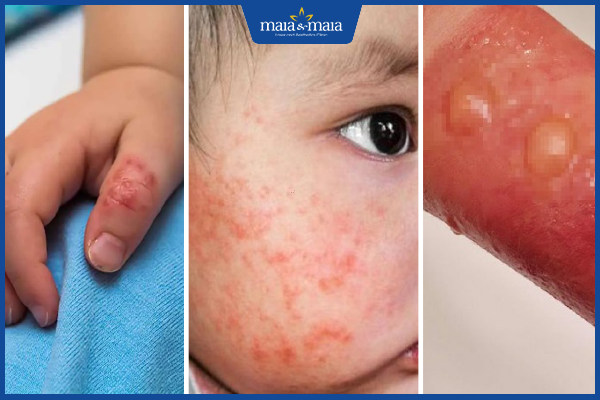 vị trí mụn nước ở trẻ