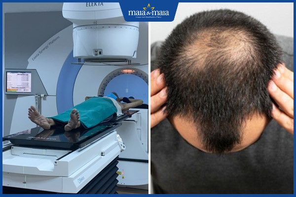 xạ trị rụng tóc