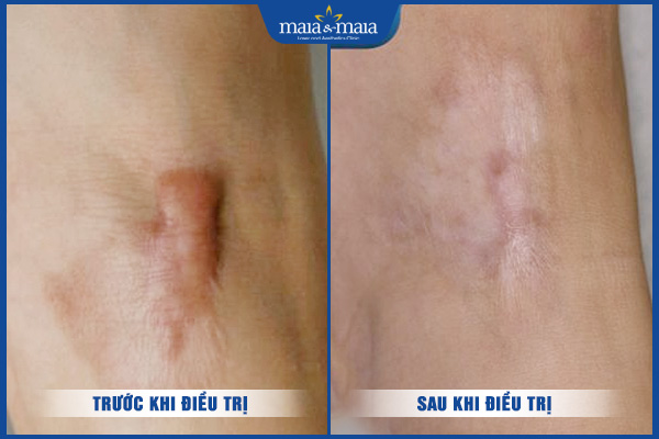 hiệu quả trị sẹo maia