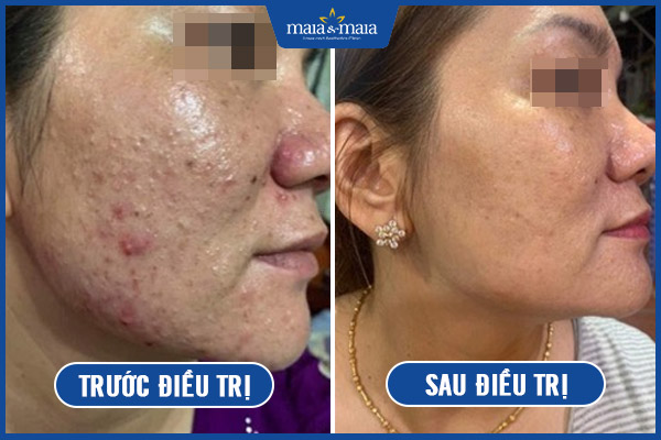 kết quả khách trị mụn