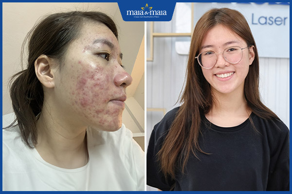 kết quả trị mụn bọc maia