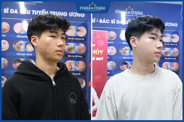 kết quả trị mụn nam