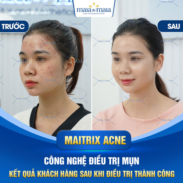 khách chữa mụn mủ thành công