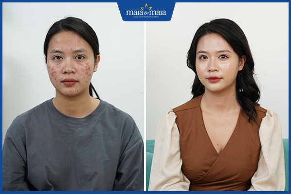 khách sau trị mụn