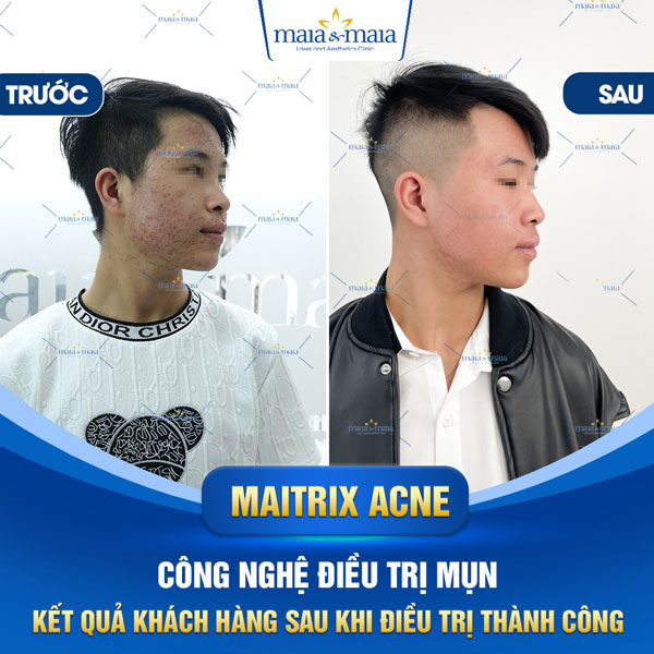 khách trị mụn bọc mủ