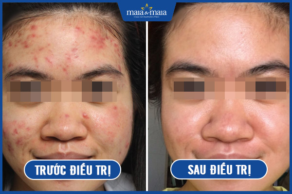 khách trị mụn