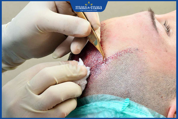 kỹ thuật cấy tóc