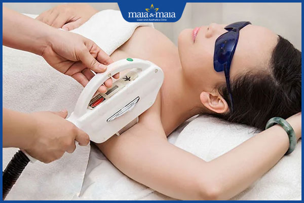 kỹ thuật triệt lông bằng laser