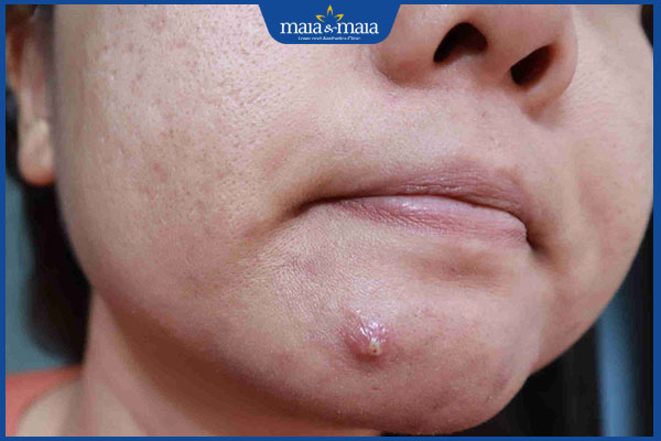 mụn bọc mủ trên mặt