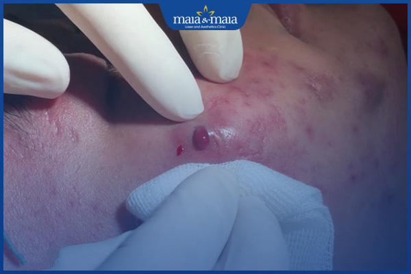 mụn bọc ở má bị vỡ