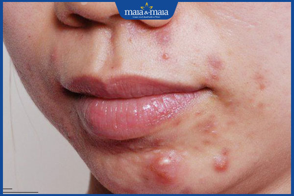 nổi mụn bọc không đầu