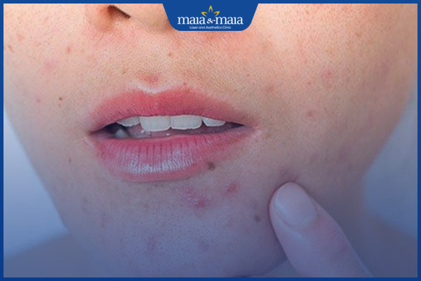 nổi mụn trứng cá do uống thuốc