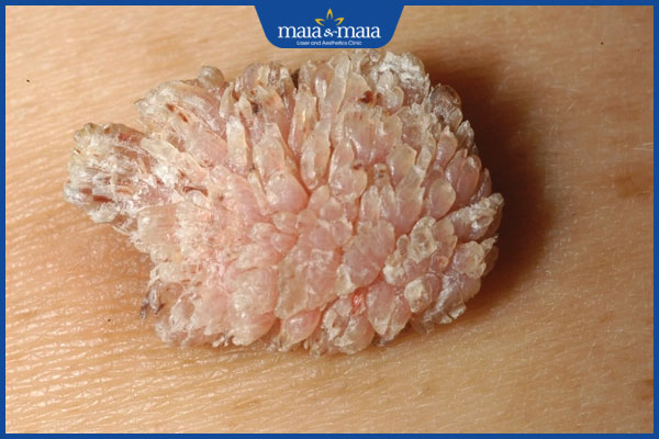 nốt sùi mào gà phát triển