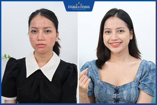 sau trị mụn bọc