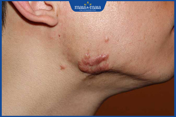 sẹo lồi bị ngứa