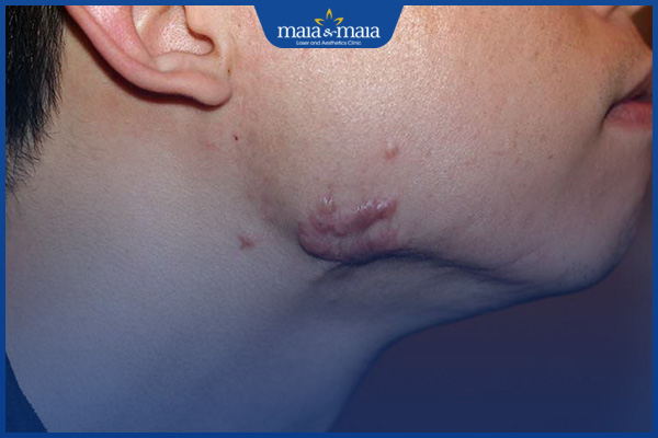 sẹo lồi sau mụn