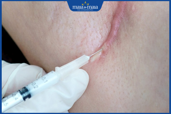 tiêm xóa sẹo lồi