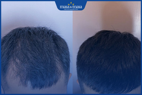 tóc mọc lại bình thường