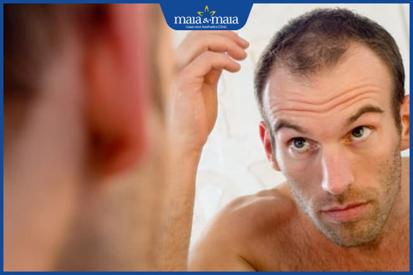 tóc rụng 2 bên thái dương