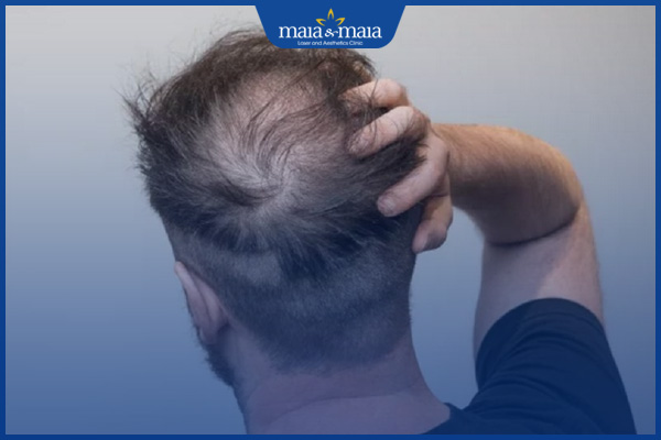 tóc rụng nhiều ở tuổi trung niên
