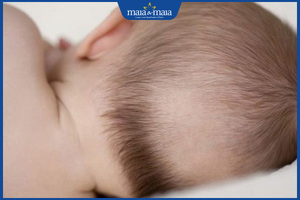 trẻ bị rụng tóc vành khăn
