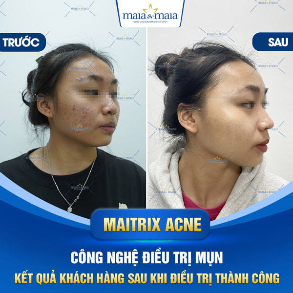 trị mụn bọc mủ tại maia