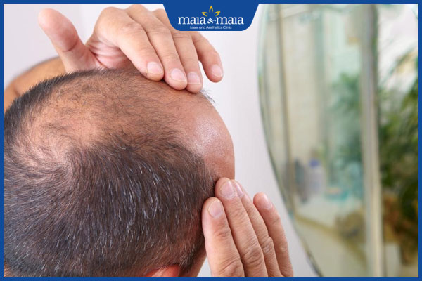 triệu chứng tóc rụng