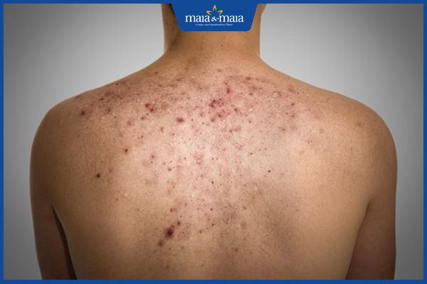 vấn đề mụn bọc lưng