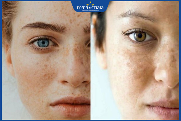 da mặt bị nám và tàn nhang