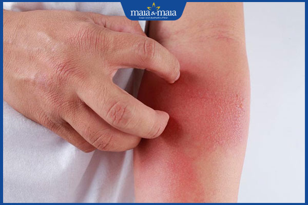 da nổi mẩn đỏ sau triệt lông