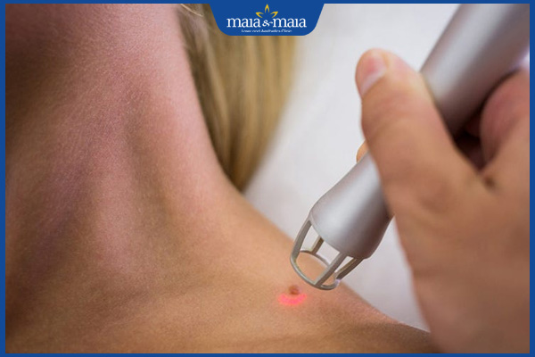đốt mụn thịt bằng laser