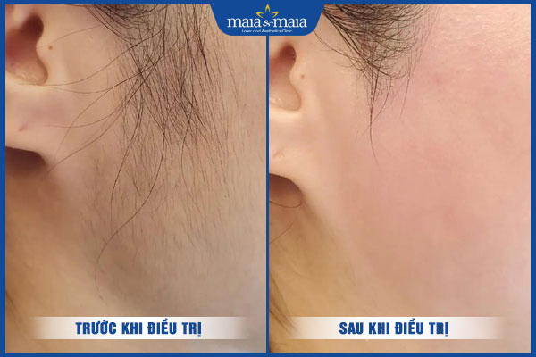hiệu quả sau triệt lông