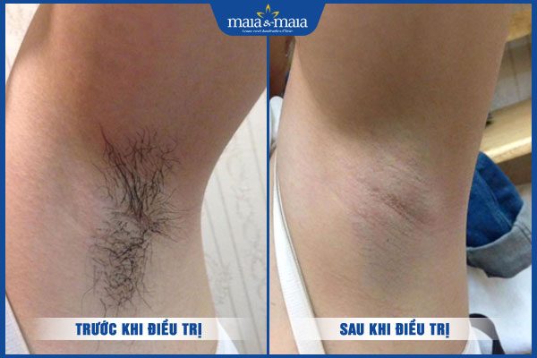 kết quả sau triệt lông