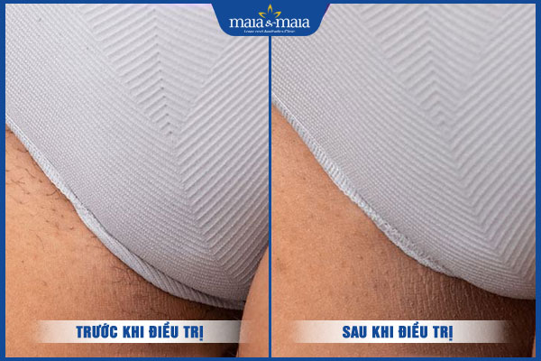 kết quả triệt lông tại maia