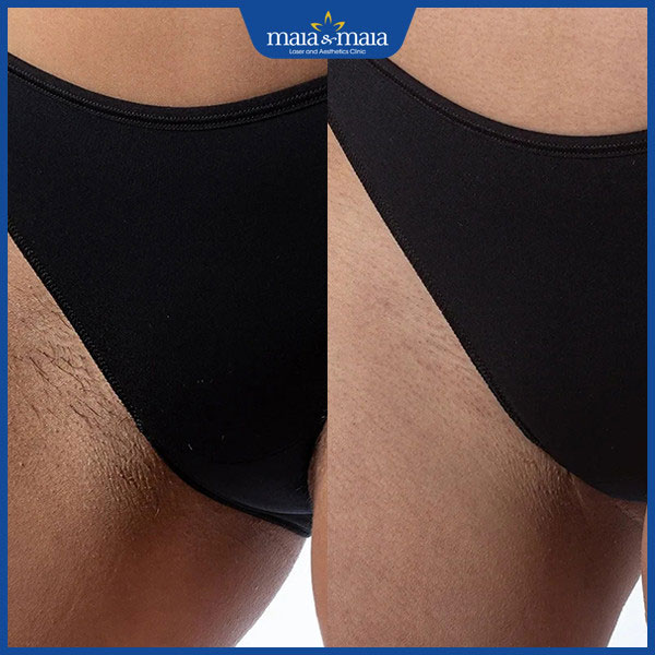 kết quả triệt lông vùng bikini