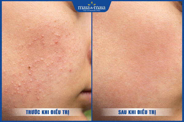 kết quả trước sau trị mụn