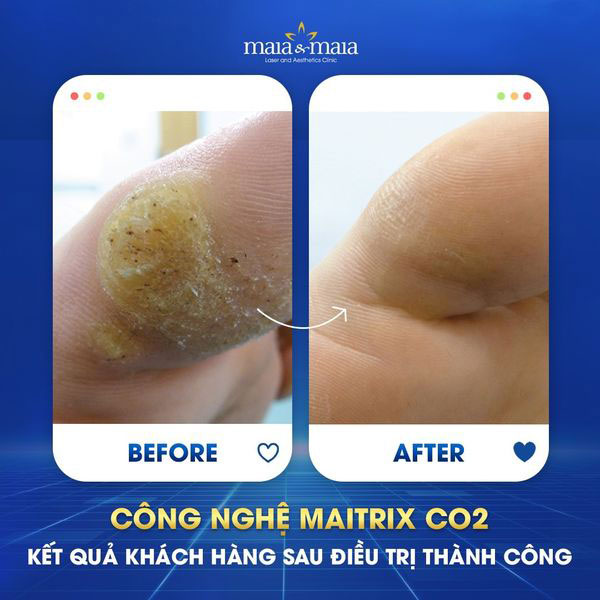 khách chữa mụn hạt cơm