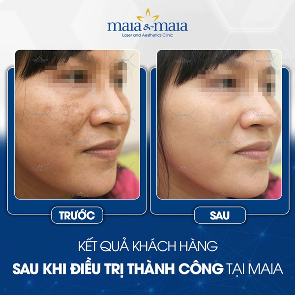 khách chữa nám tại maia