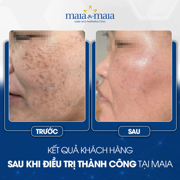 khách chữa nám
