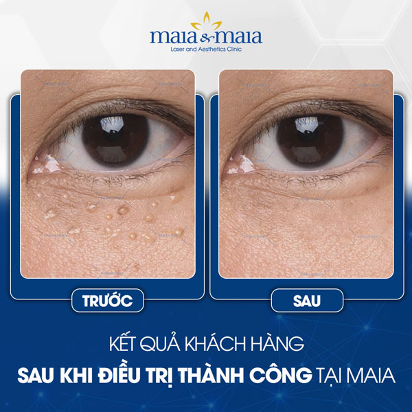 khách hàng chữa mụn thịt thành công
