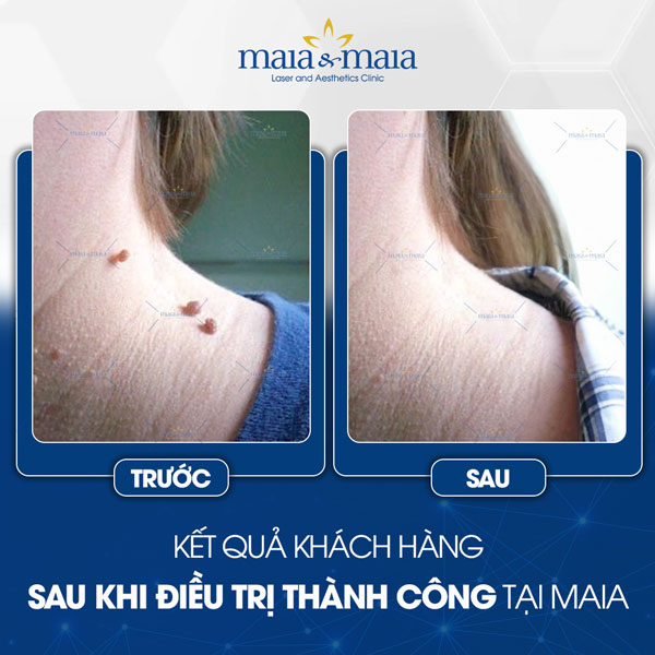 khách hàng chữa mụn thịt