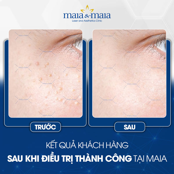 khách hàng trị mụn thịt tại maia