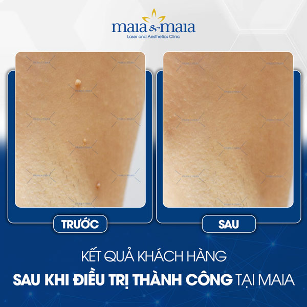 khách hàng trị mụn thịt thành công