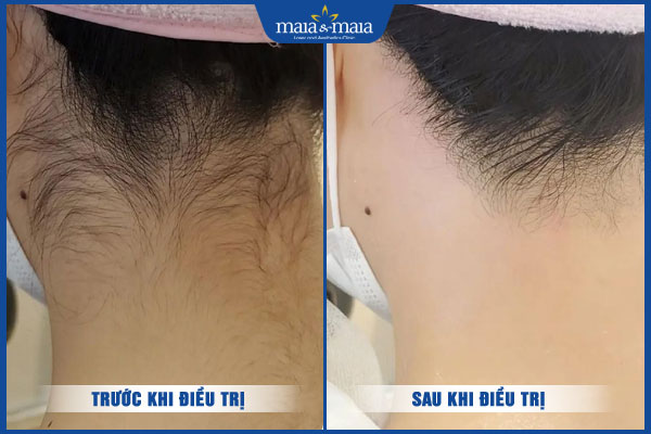 khách hàng triệt lông tại maia