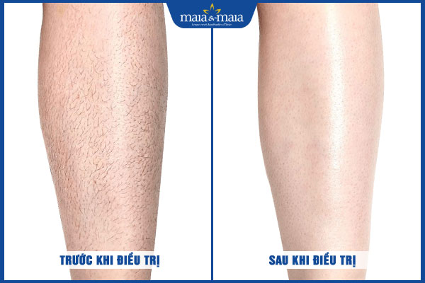 khách hàng triệt lông thành công