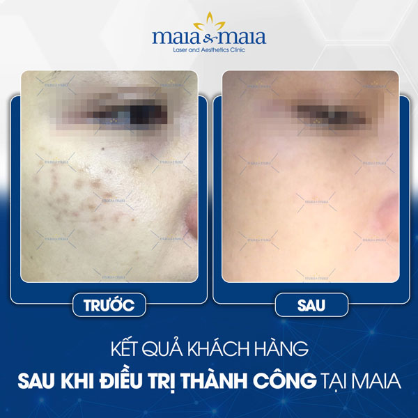 khách trị nám tại maia